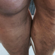 Illustration for article titled Rybacks Staph Infection Is Very Gross